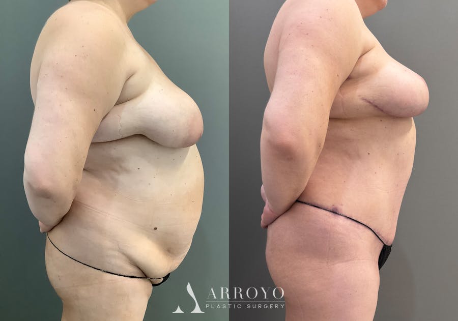 Tummy Tuck Before & After Gallery - Patient 185271 - Image 2