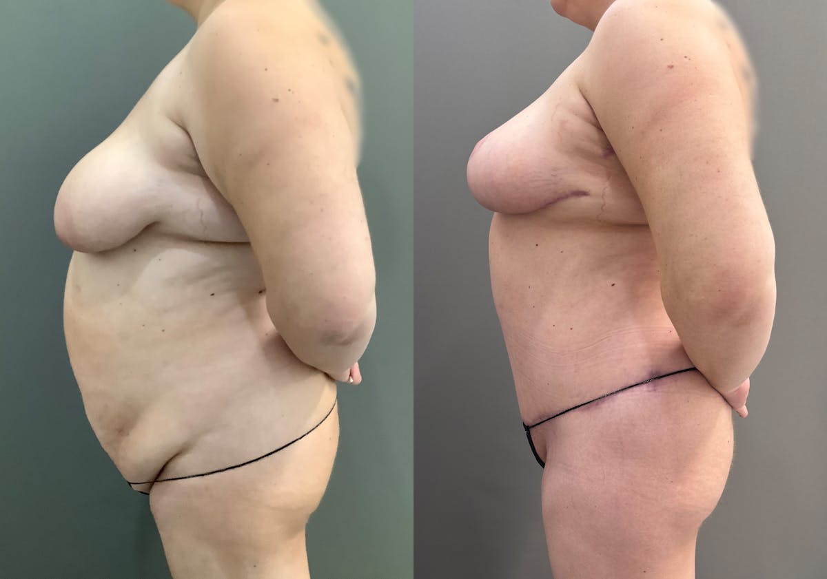 Tummy Tuck Before & After Gallery - Patient 185271 - Image 3