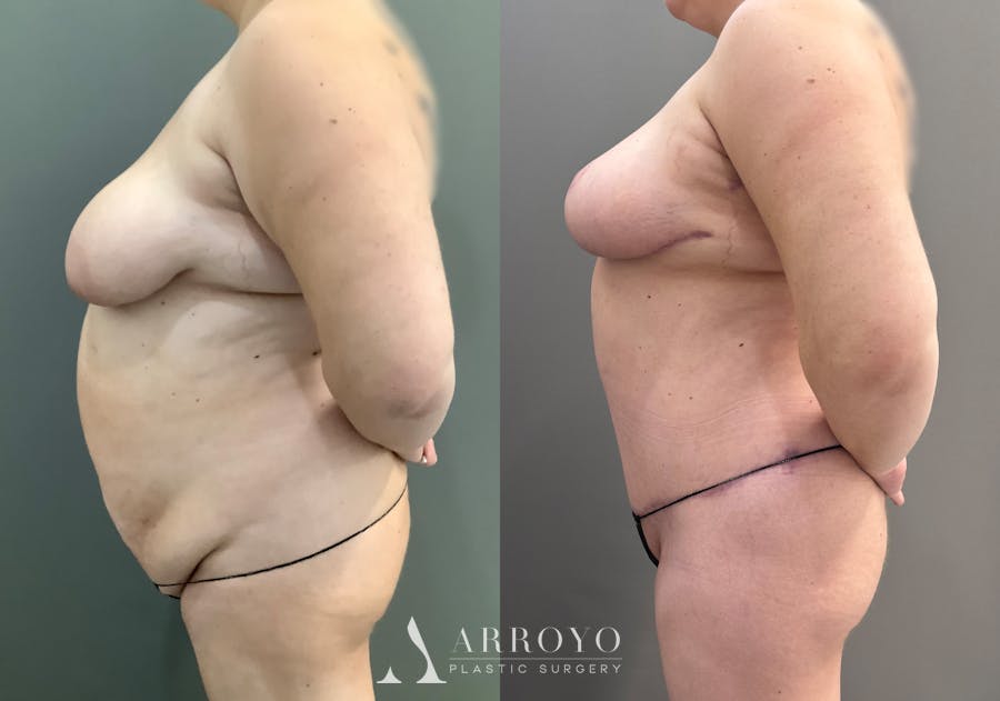 Tummy Tuck Before & After Gallery - Patient 185271 - Image 3