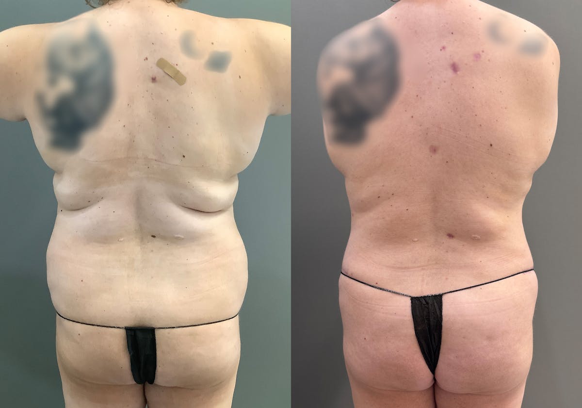 Tummy Tuck Before & After Gallery - Patient 185271 - Image 4