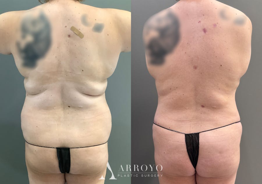 Tummy Tuck Before & After Gallery - Patient 185271 - Image 4