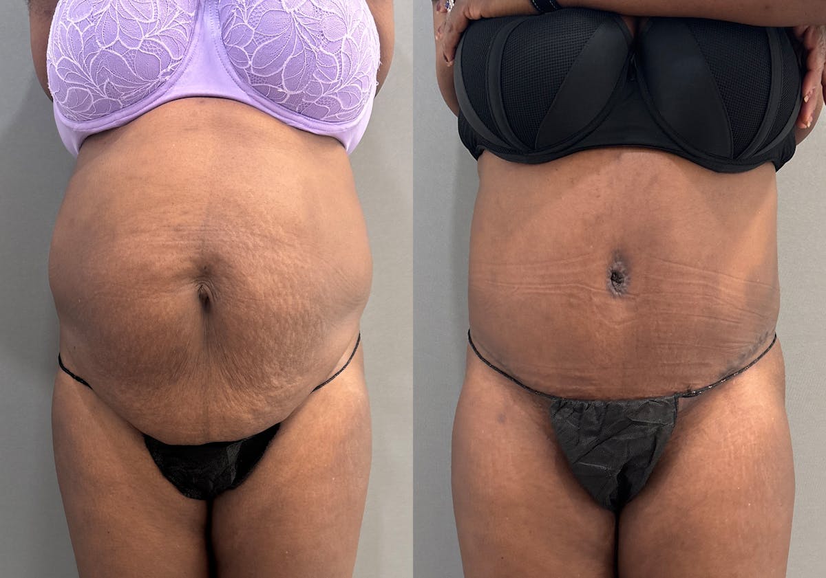 Tummy Tuck Before & After Gallery - Patient 427988 - Image 1