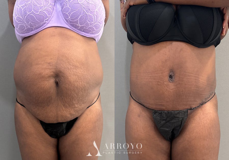 Tummy Tuck Before & After Gallery - Patient 427988 - Image 1