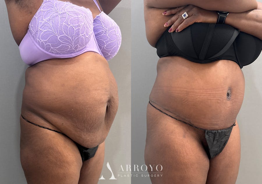 Tummy Tuck Before & After Gallery - Patient 427988 - Image 2