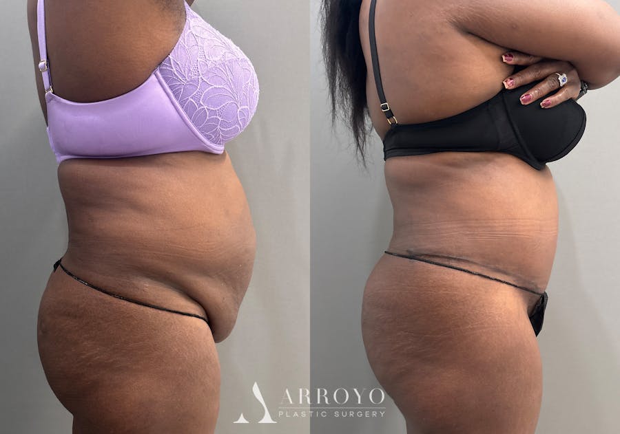 Tummy Tuck Before & After Gallery - Patient 427988 - Image 3