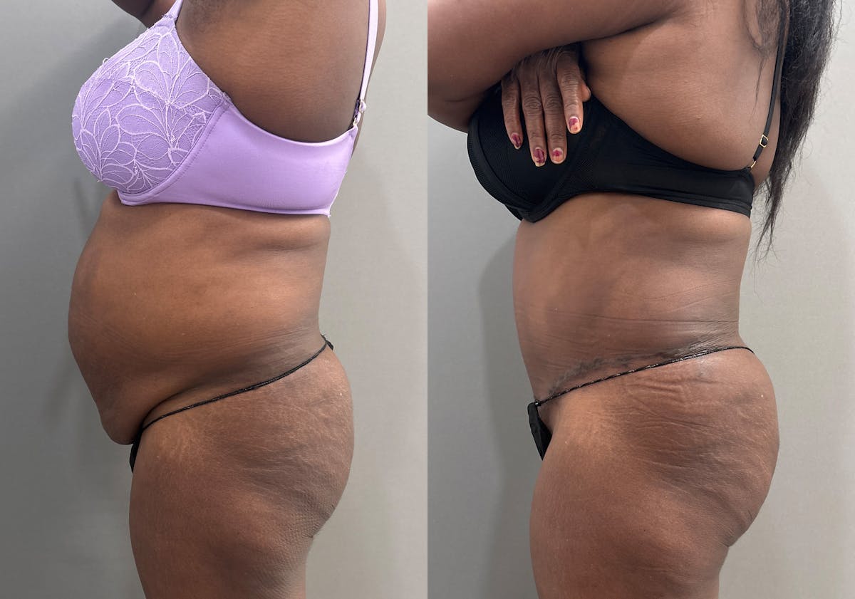Tummy Tuck Before & After Gallery - Patient 427988 - Image 4