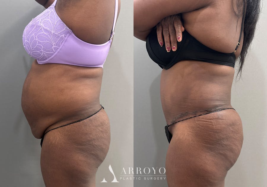 Tummy Tuck Before & After Gallery - Patient 427988 - Image 4