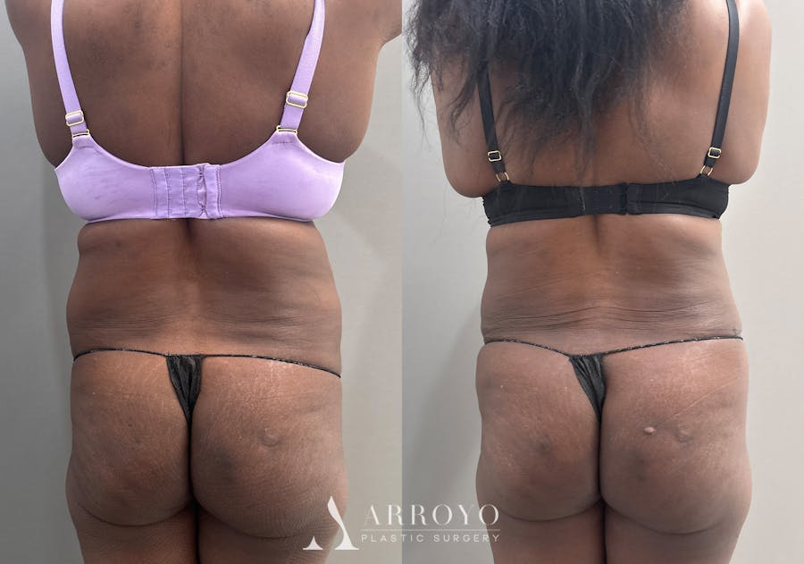 Tummy Tuck Before & After Gallery - Patient 427988 - Image 5