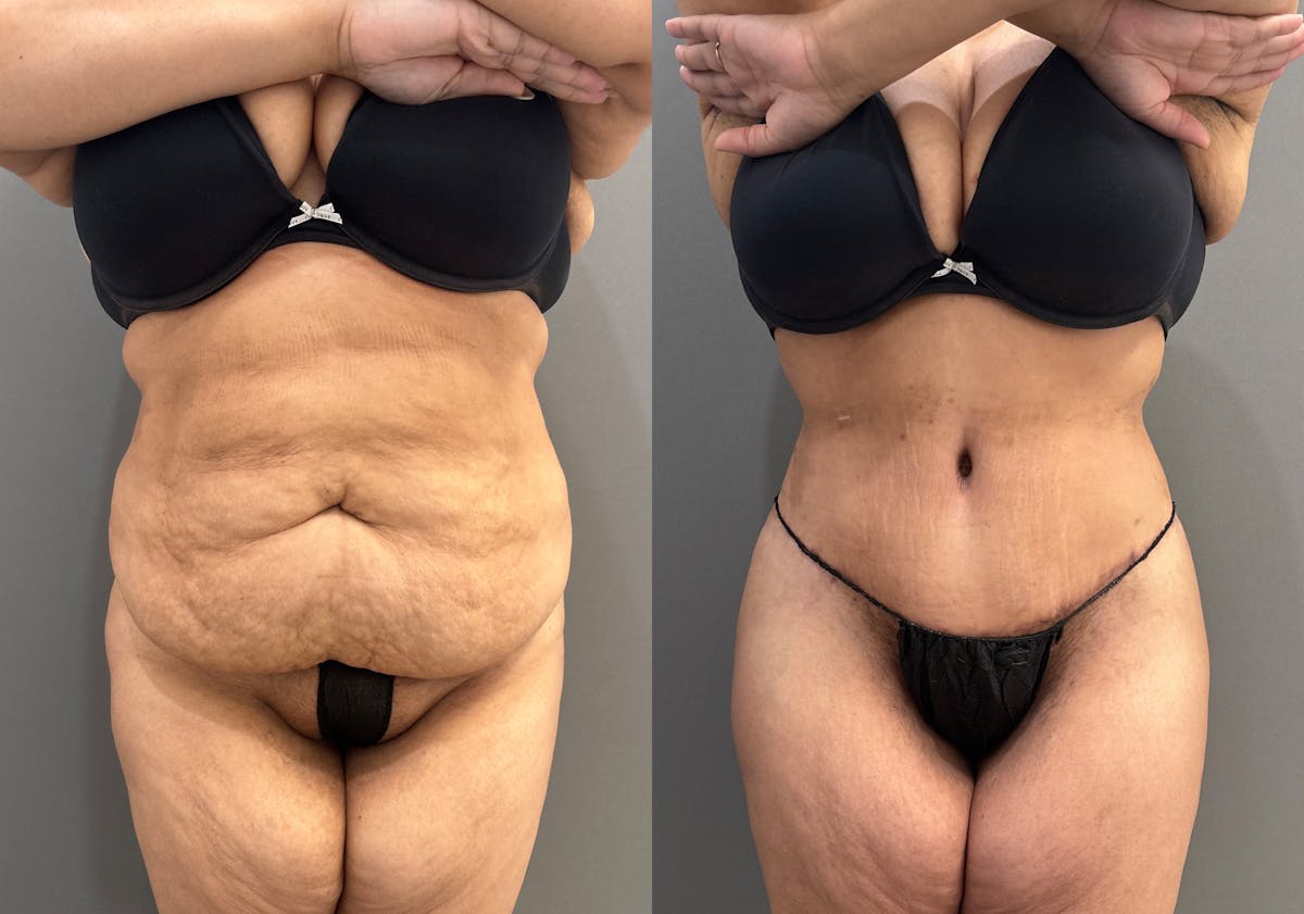 Liposuction Before & After Gallery - Patient 367844 - Image 1