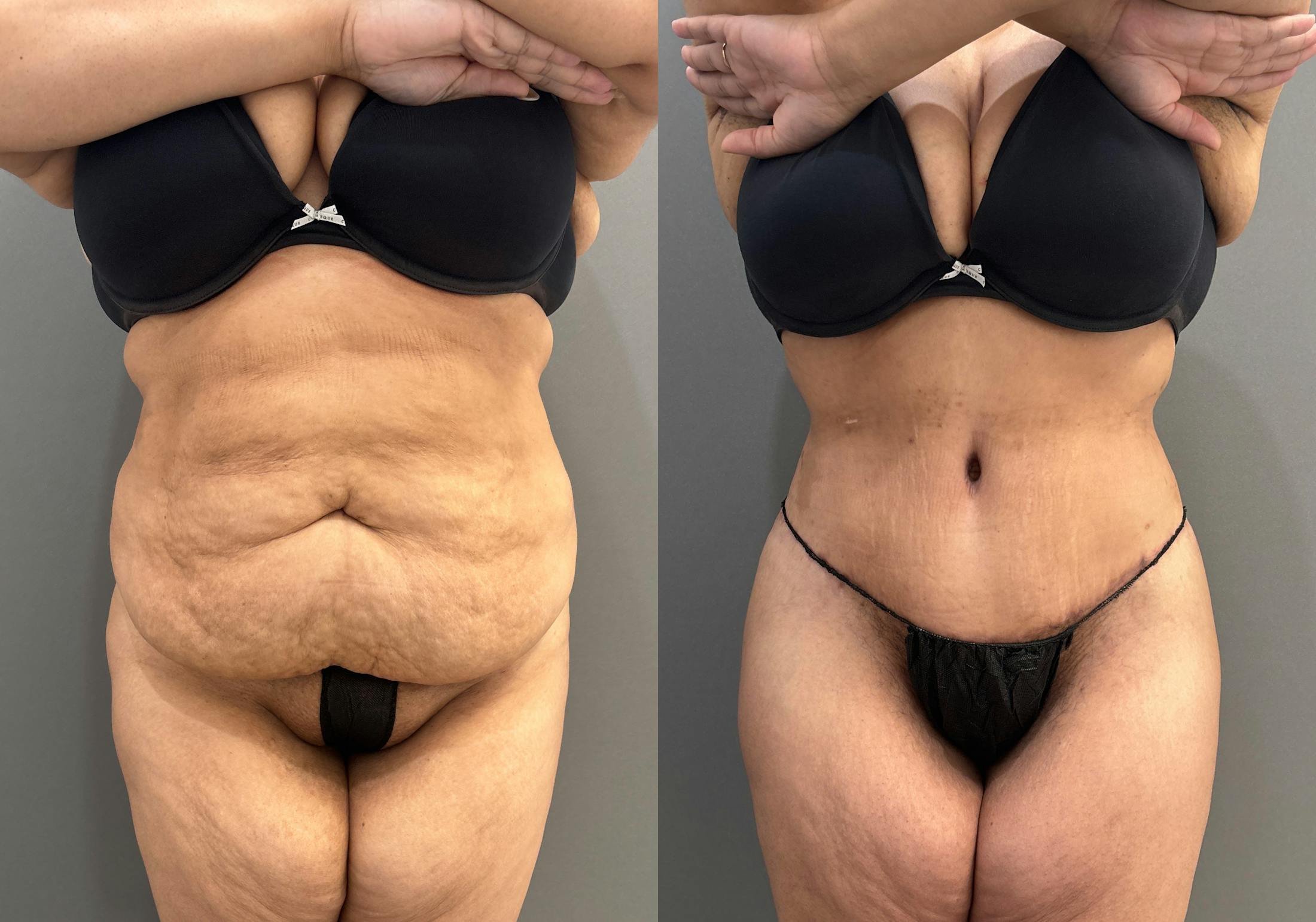 Tummy Tuck Before & After Gallery - Patient 335216 - Image 1