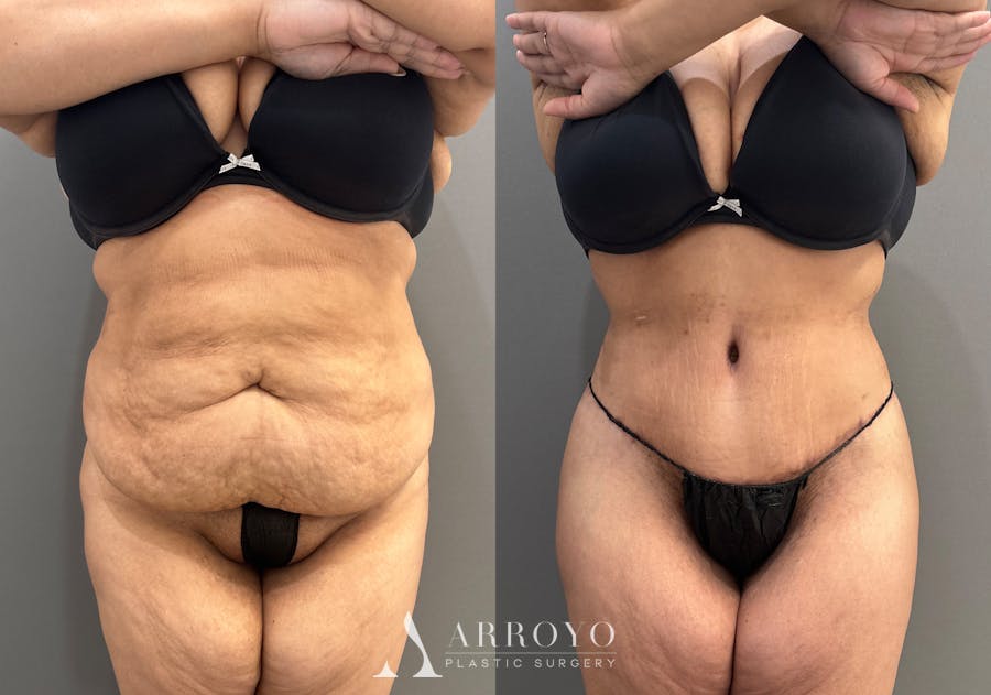 Tummy Tuck Before & After Gallery - Patient 335216 - Image 1