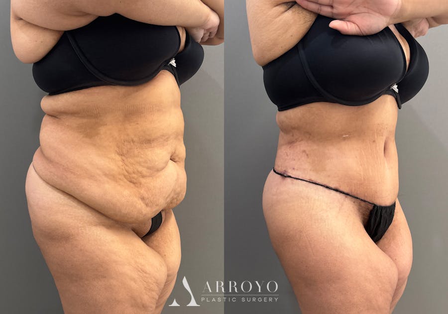 Tummy Tuck Before & After Gallery - Patient 335216 - Image 2