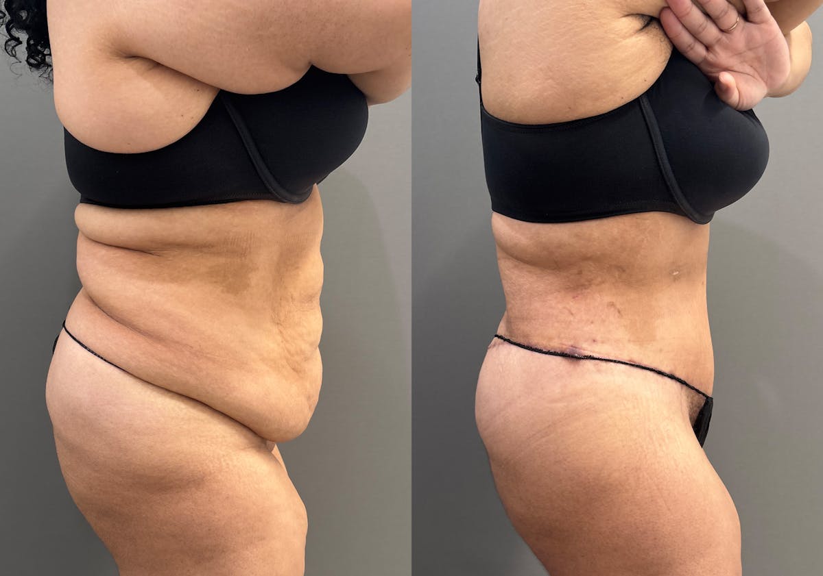 Liposuction Before & After Gallery - Patient 367844 - Image 3
