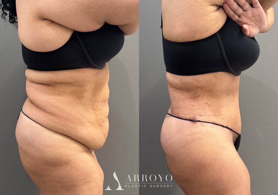 Tummy Tuck Before & After Gallery - Patient 335216 - Image 3