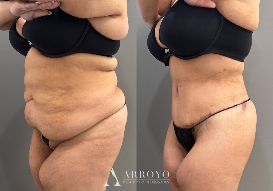 Tummy Tuck Before & After Gallery - Patient 335216 - Image 4