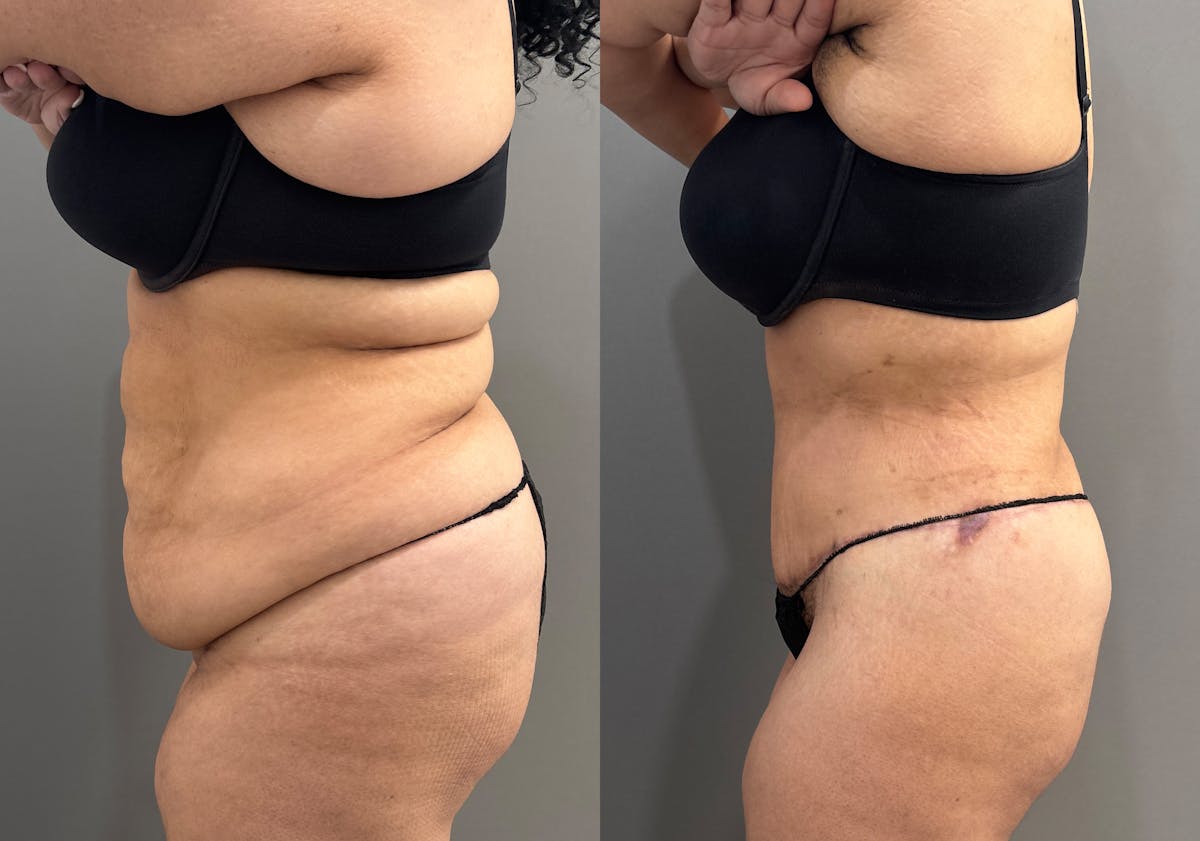 Liposuction Before & After Gallery - Patient 367844 - Image 5