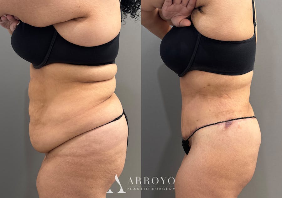 Tummy Tuck Before & After Gallery - Patient 335216 - Image 5