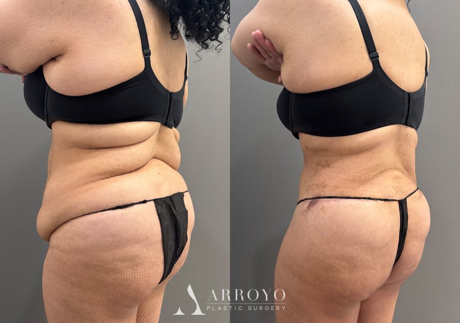 Tummy Tuck Before & After Gallery - Patient 335216 - Image 6
