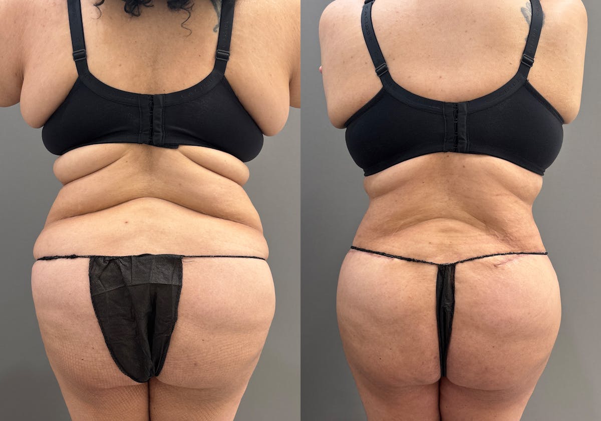 Liposuction Before & After Gallery - Patient 367844 - Image 7