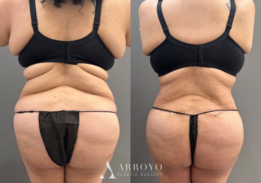 Tummy Tuck Before & After Gallery - Patient 335216 - Image 7