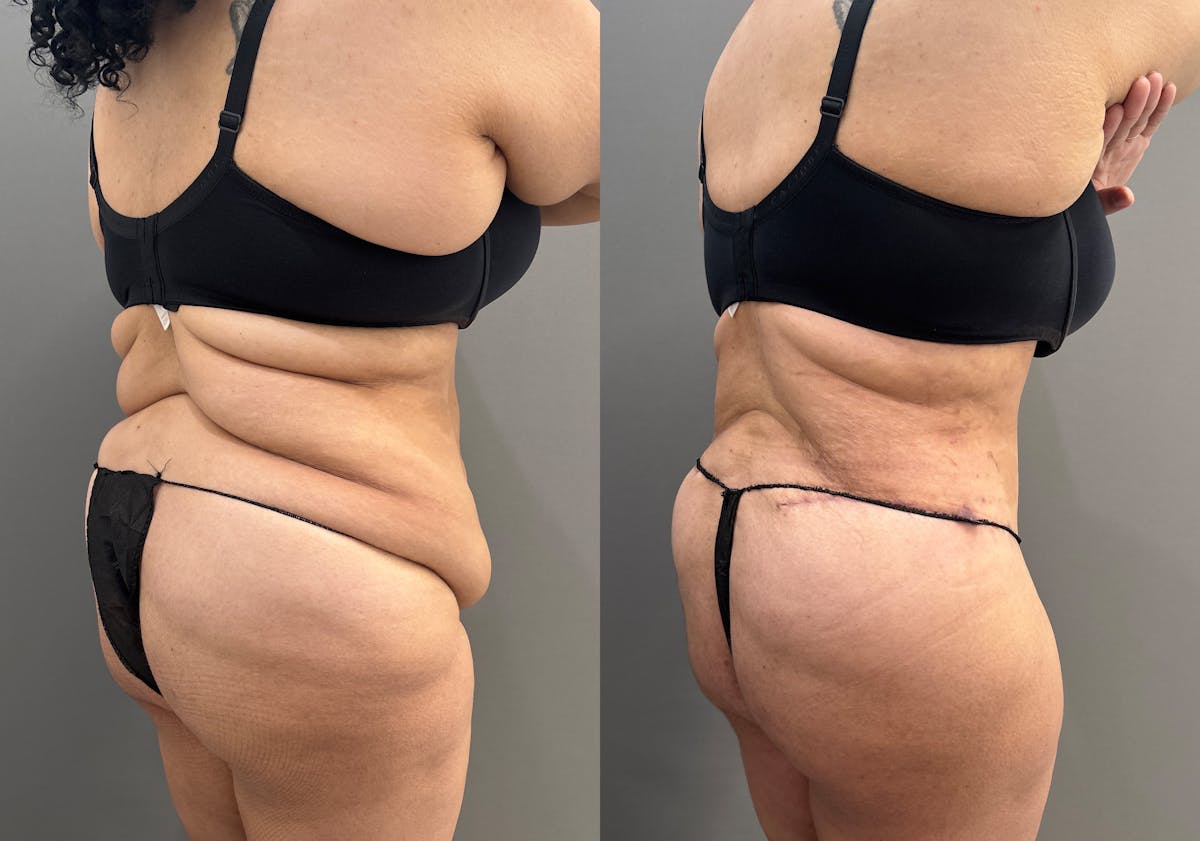 Liposuction Before & After Gallery - Patient 367844 - Image 8