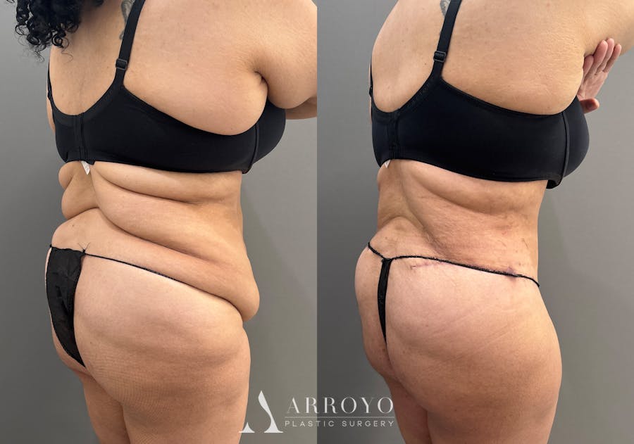 Tummy Tuck Before & After Gallery - Patient 335216 - Image 8