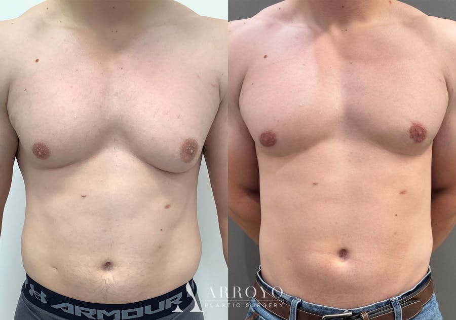 Gynecomastia Before & After Gallery - Patient 492537 - Image 1