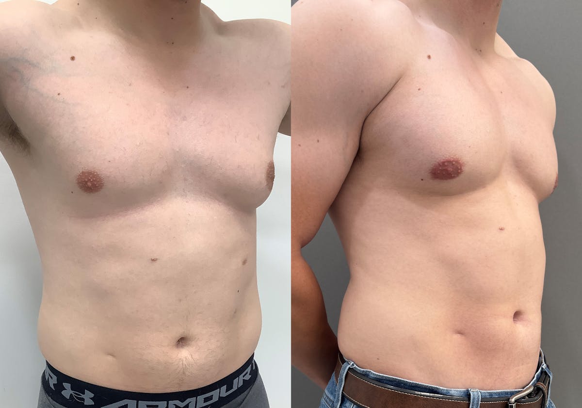 Gynecomastia Before & After Gallery - Patient 492537 - Image 2