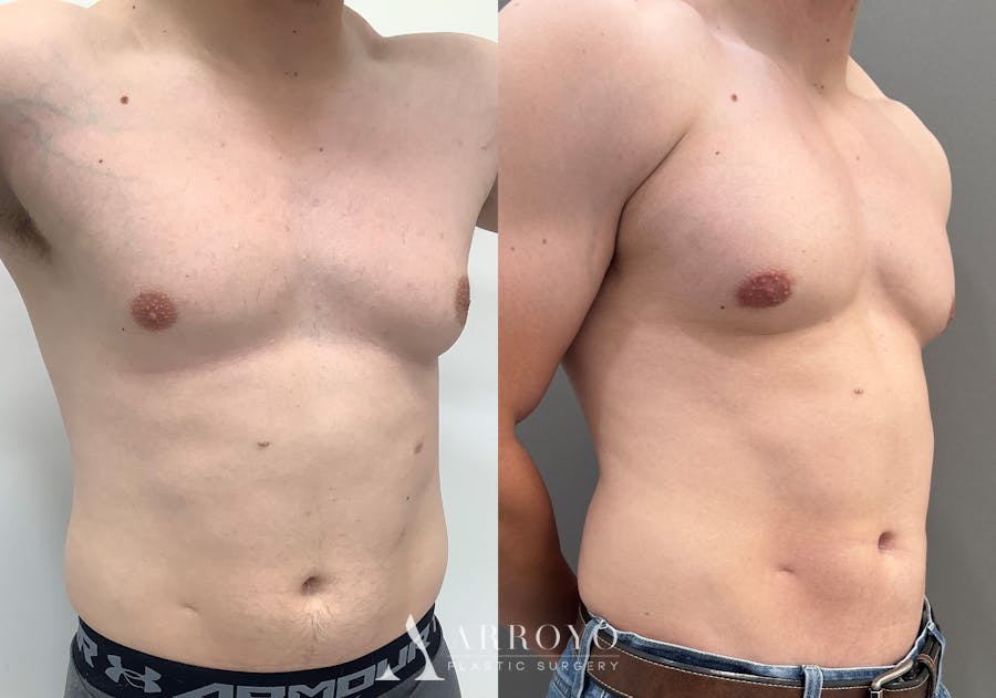 Gynecomastia Before & After Gallery - Patient 492537 - Image 2