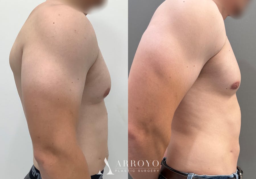 Gynecomastia Before & After Gallery - Patient 492537 - Image 3