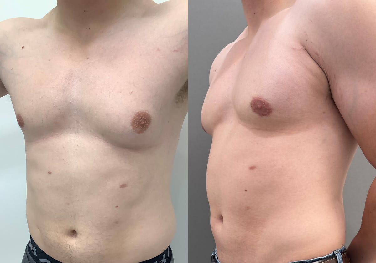 Gynecomastia Before & After Gallery - Patient 492537 - Image 4