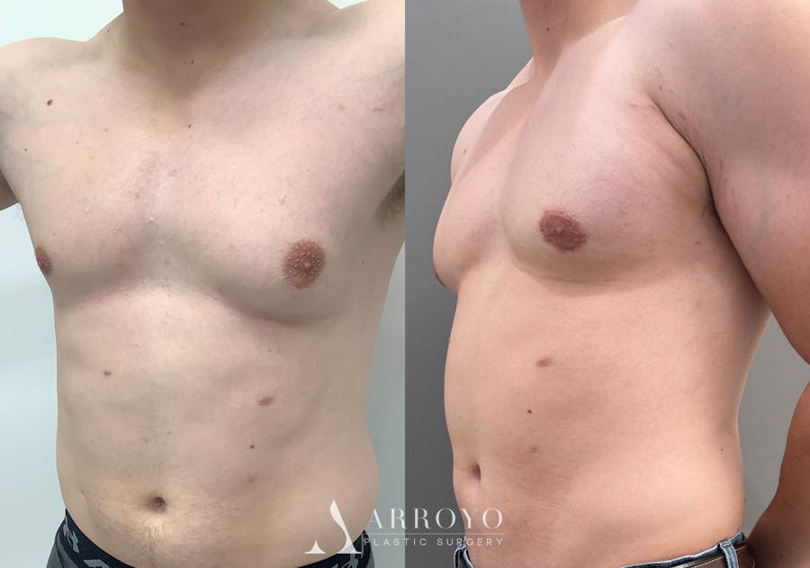 Gynecomastia Before & After Gallery - Patient 492537 - Image 4
