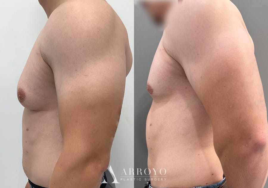 Gynecomastia Before & After Gallery - Patient 492537 - Image 5