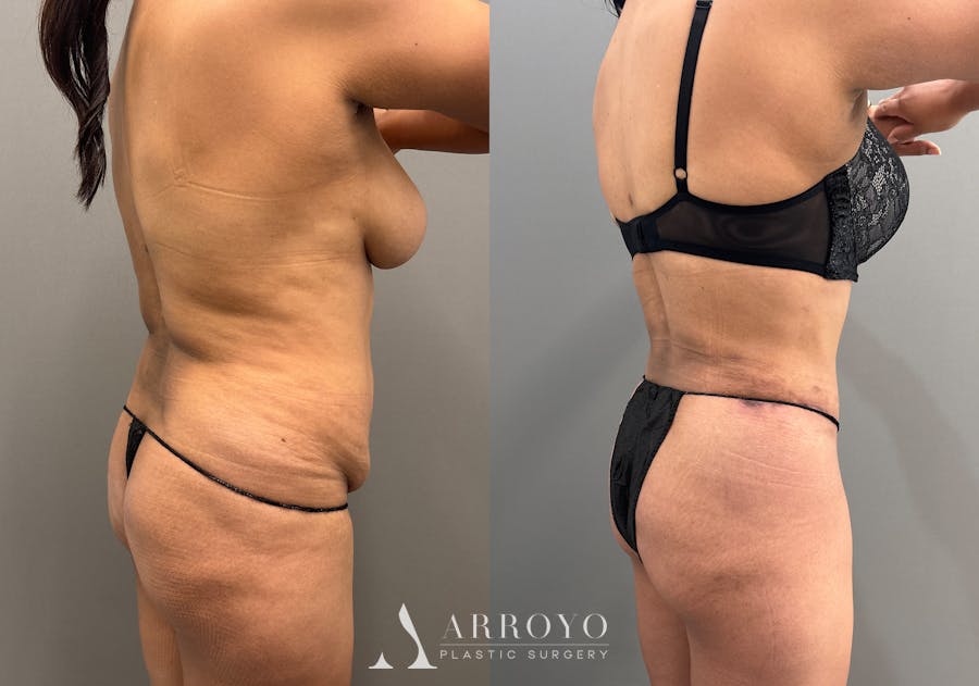 Tummy Tuck Before & After Gallery - Patient 351197 - Image 3