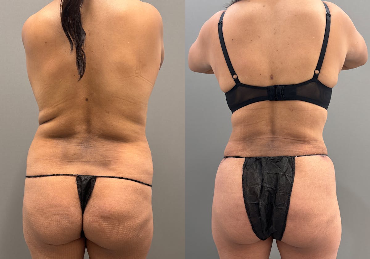 Tummy Tuck Before & After Gallery - Patient 351197 - Image 6