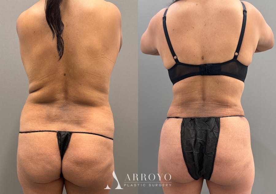 Tummy Tuck Before & After Gallery - Patient 351197 - Image 6