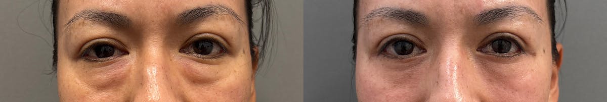 Blepharoplasty Before & After Gallery - Patient 281420 - Image 1