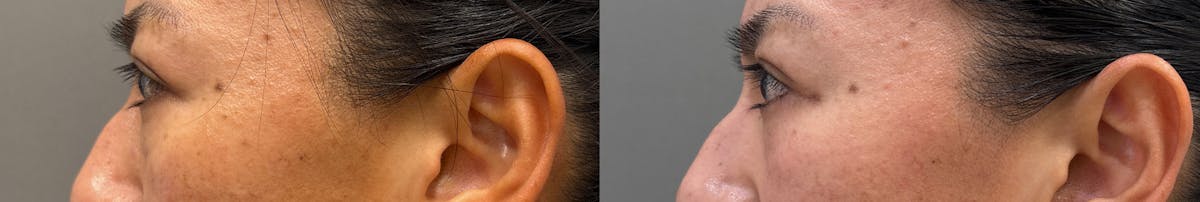 Blepharoplasty Before & After Gallery - Patient 281420 - Image 5