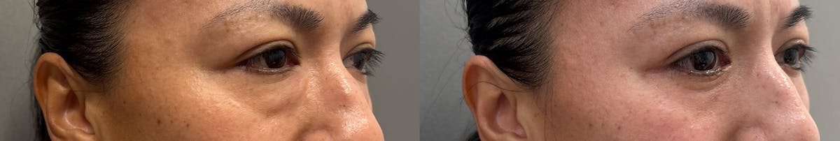 Blepharoplasty Before & After Gallery - Patient 281420 - Image 2