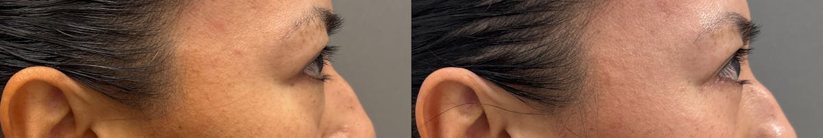 Blepharoplasty Before & After Gallery - Patient 281420 - Image 3