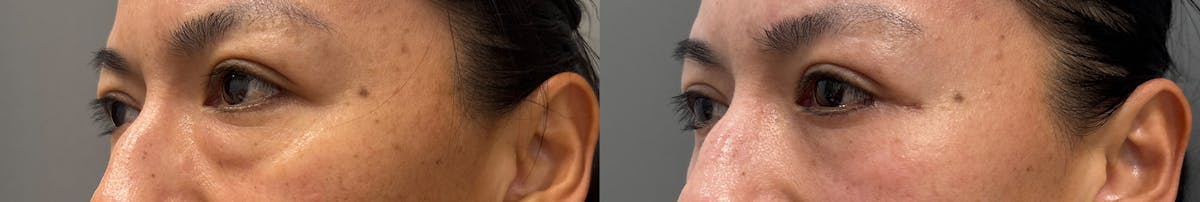 Blepharoplasty Before & After Gallery - Patient 281420 - Image 4