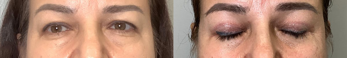 Blepharoplasty Before & After Gallery - Patient 141595076 - Image 1