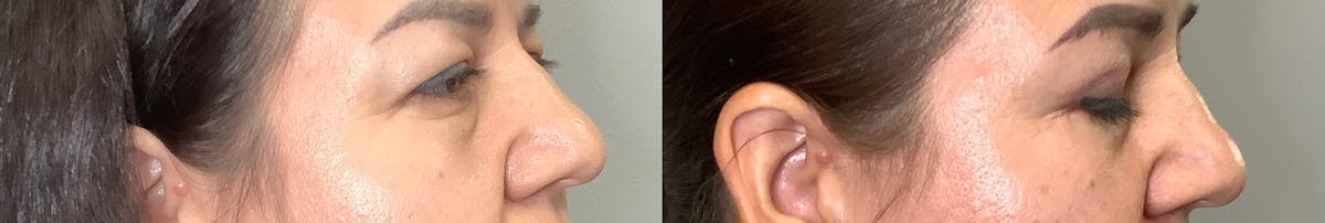 Blepharoplasty Before & After Gallery - Patient 141595076 - Image 2