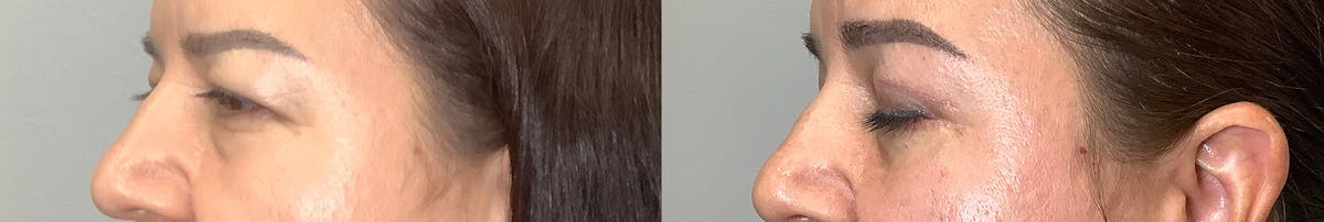 Blepharoplasty Before & After Gallery - Patient 141595076 - Image 3