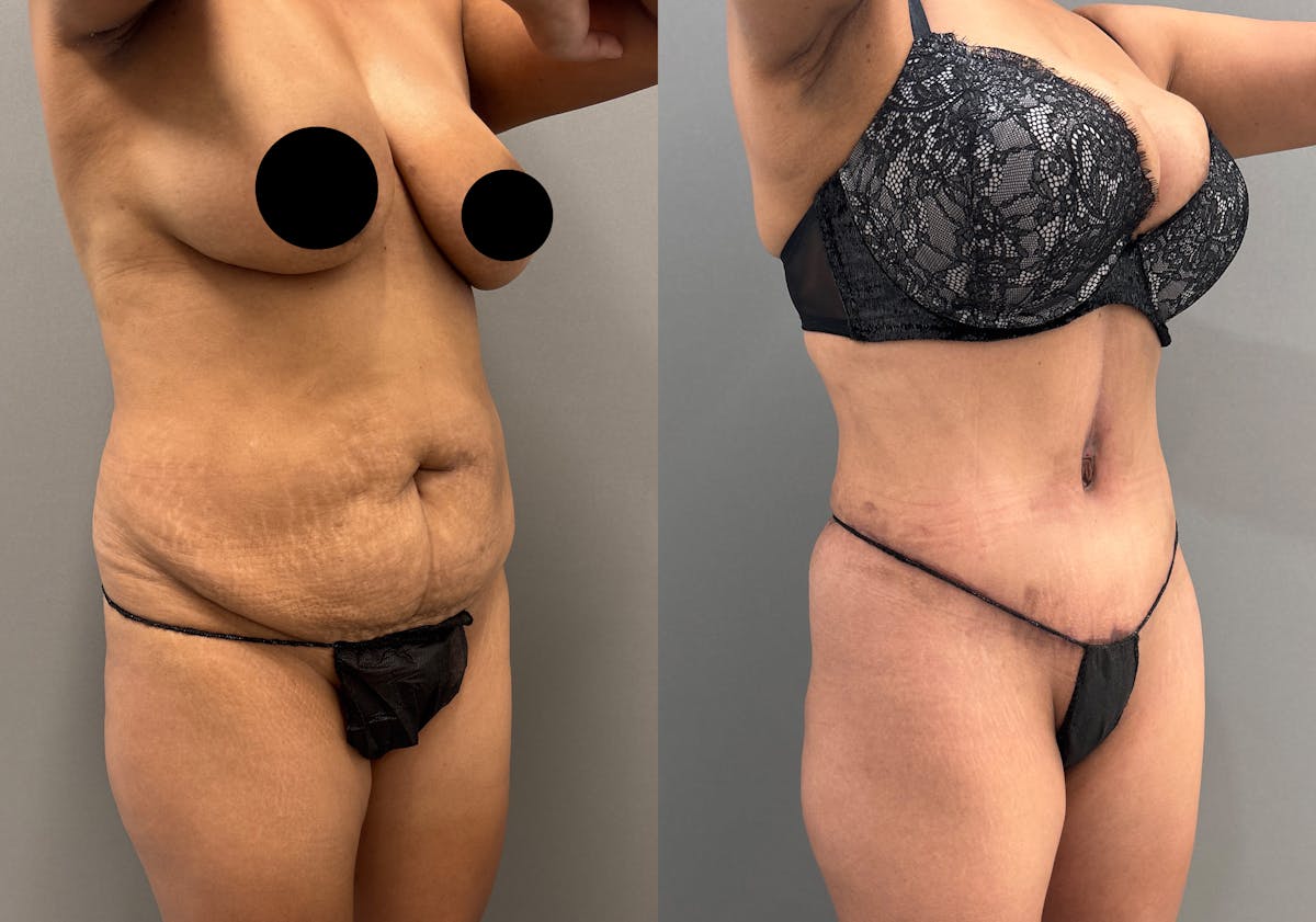 Tummy Tuck Before & After Gallery - Patient 351197 - Image 2
