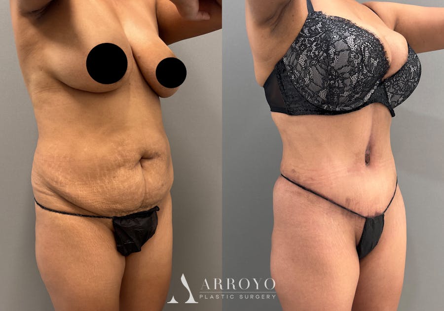 Tummy Tuck Before & After Gallery - Patient 351197 - Image 2