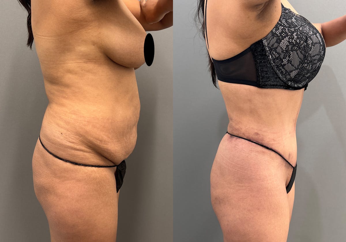 Tummy Tuck Before & After Gallery - Patient 351197 - Image 5