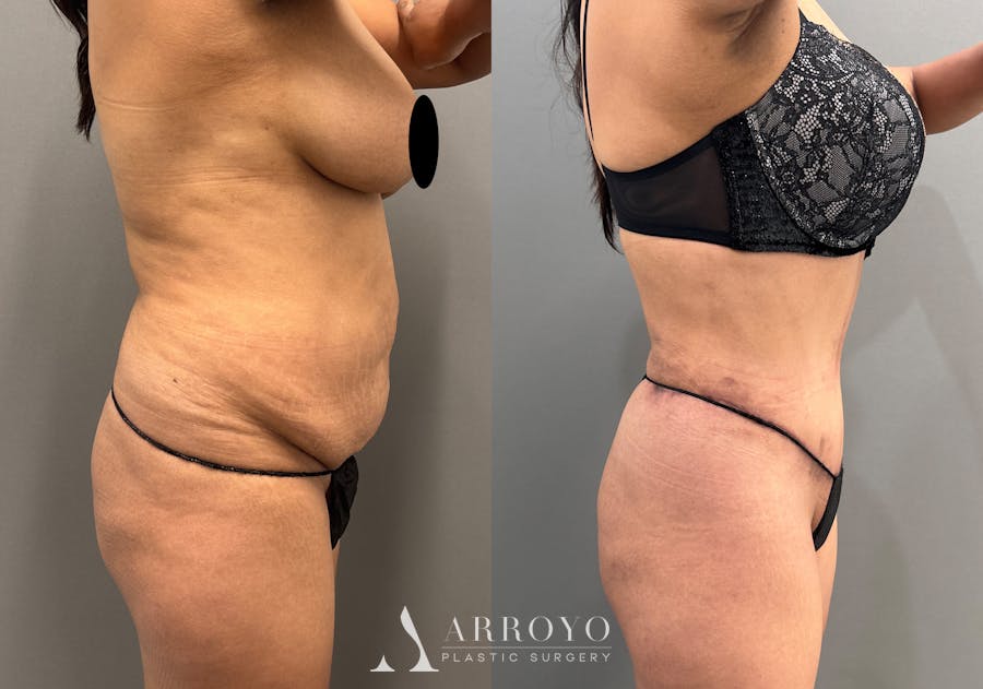 Tummy Tuck Before & After Gallery - Patient 351197 - Image 5