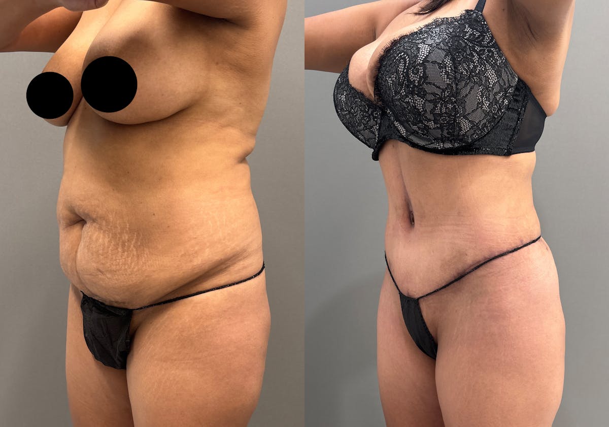 Tummy Tuck Before & After Gallery - Patient 351197 - Image 4