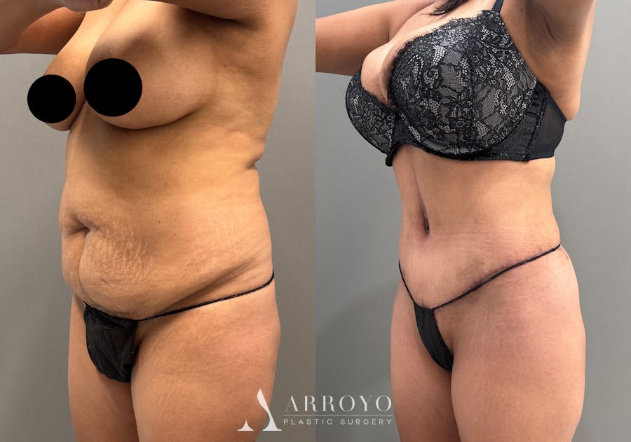 Tummy Tuck Before & After Gallery - Patient 351197 - Image 4